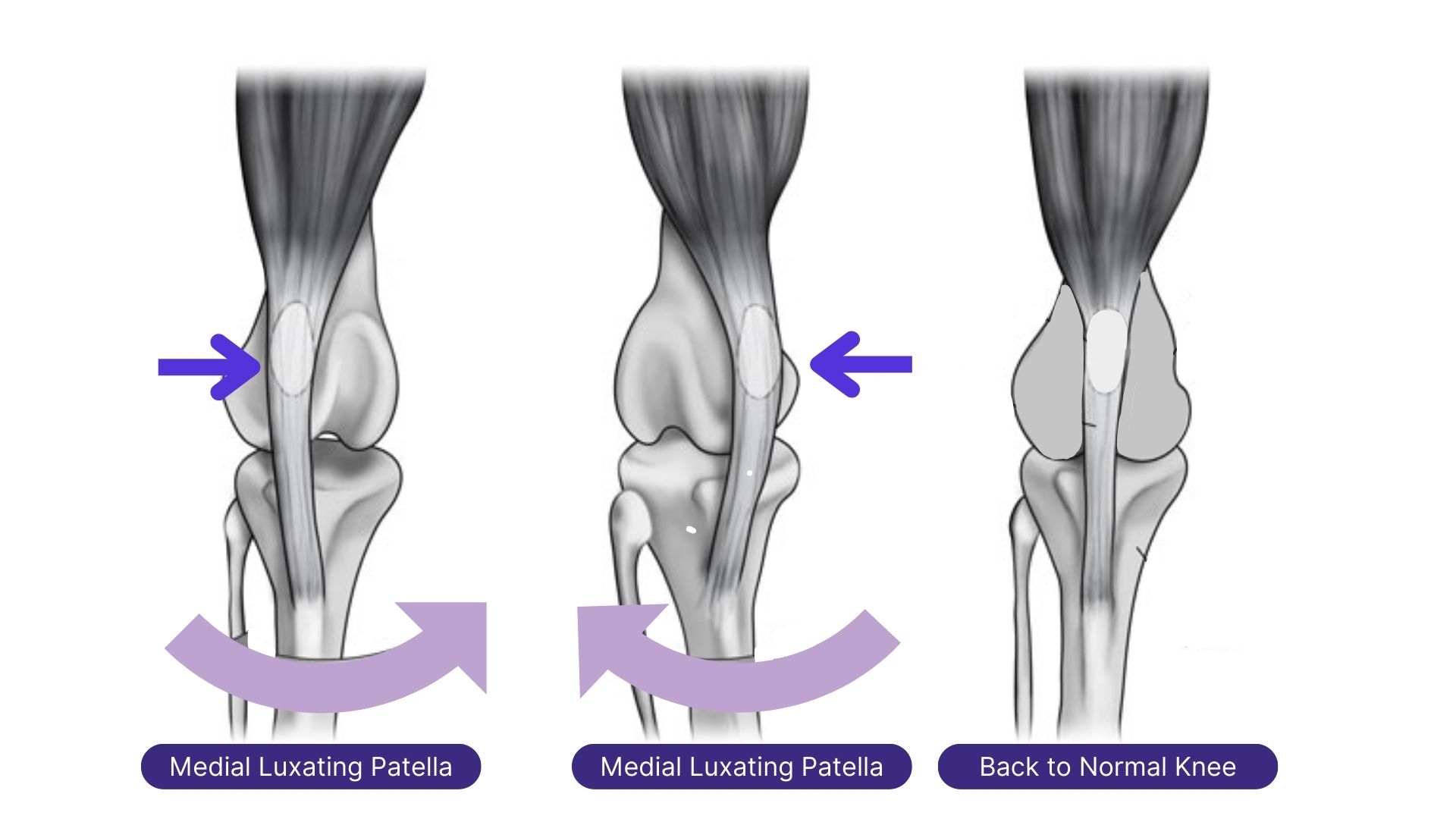 Medial or Lateral Release