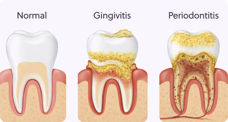 Diagram comparing a normal tooth, a tooth with gingivitis showing plaque buildup, and a tooth with periodontitis showing gum recession and tissue damage.